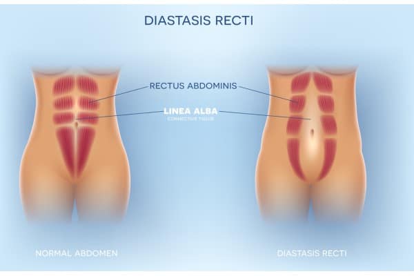 What Non-Surgical Options Are Available for Diastasis Recti Oxford?