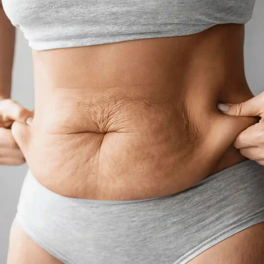 Is It Normal to Have Loose Skin After Pregnancy Oxford?