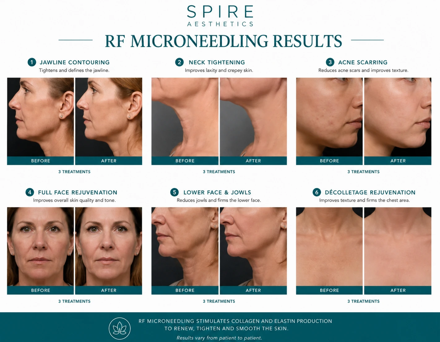 RF Microneedling Skin tightening Oxford results