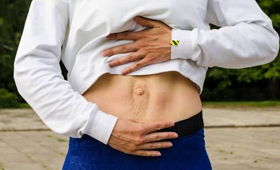 When Could Diastasis Recti Be the Missing Piece of the Puzzle Oxford?