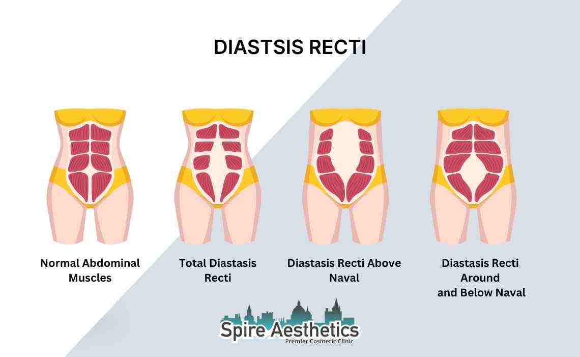 Is Non-Surgical Diastasis Recti Treatment Right for You? Common Concerns Answered Oxford